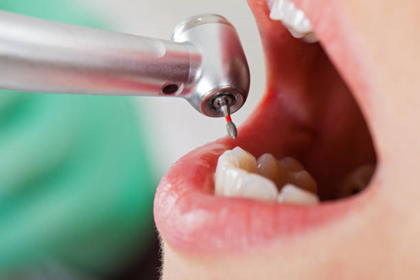 Best Chipped Tooth Repair Near Me  in Quail Creek, TX